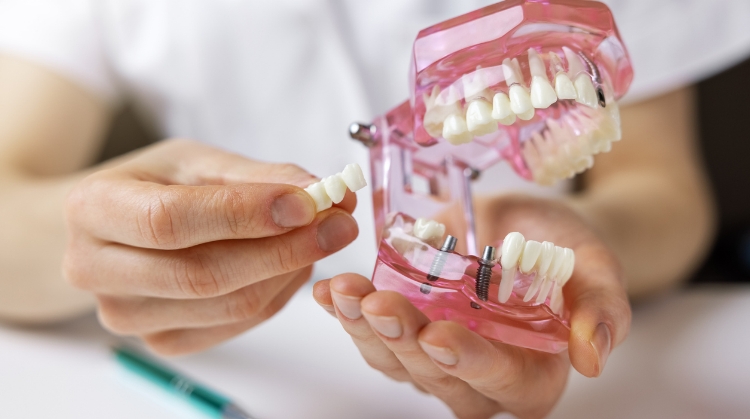 Close-up of a dentist holding a dental model with implants, showing how dentures are secured to dental implants.